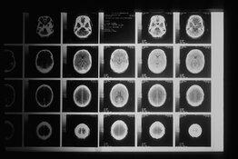 Grey Matters Health Inc. Advances US Alzheimer's Clinics